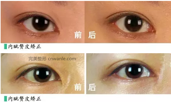內(nèi)眥贅皮