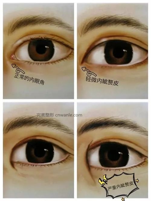 開眼角真的能使你眼睛變美嗎？