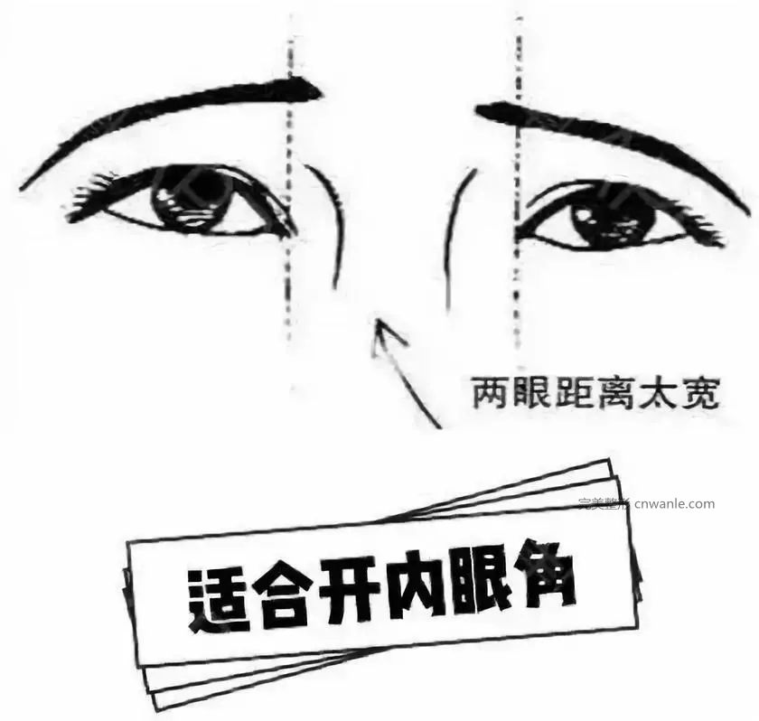 開眼角真的能使你眼睛變美嗎？
