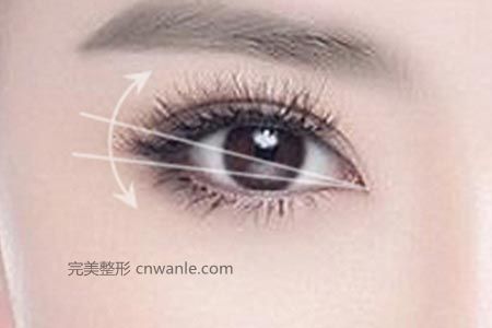 什么是開眼角，真的可以讓眼睛變大嗎