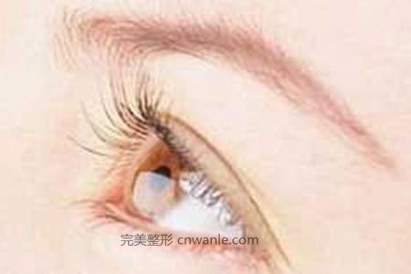 什么是開眼角，真的可以讓眼睛變大嗎