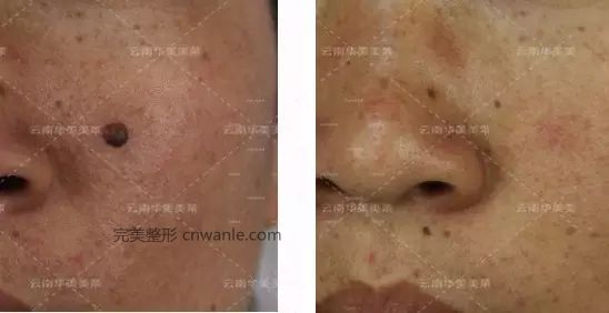 激光去痣的效果怎么樣