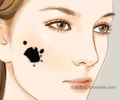 激光<a href='/tag_quzhi11.html'>去痣</a>的效果怎么樣