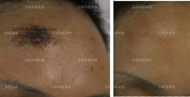 激光去痣的效果怎么樣
