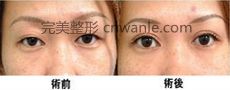 <a href='/tag_kaiyanjiao68.html'>開眼角</a>眼睛會(huì)變大嗎