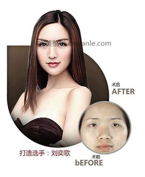 昆明美萊開眼角會讓眼睛變大嗎？