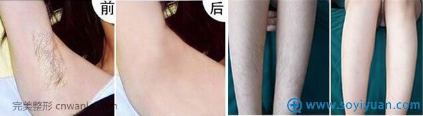 佛山蘇李秀英冰點(diǎn)脫毛前后對(duì)比照片