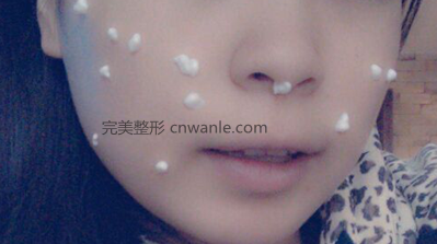 激光去痣之敷麻藥
