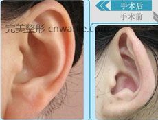 耳畸形矯正手術(shù)禁忌癥
