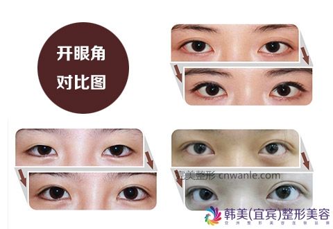 開內(nèi)眥真的可以放大眼睛嗎?宜賓眼部整形哪家好? 開內(nèi)眥真的可以放大眼睛嗎?宜賓眼部<a href='/tag_zhengxingnajiahao.html'>整形哪家好</a>?