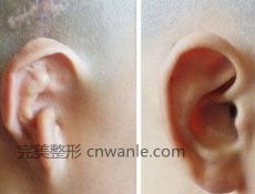 耳垂損傷矯正術(shù)