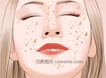 激光點(diǎn)痣的效果怎么樣