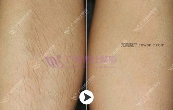冰點脫毛案例