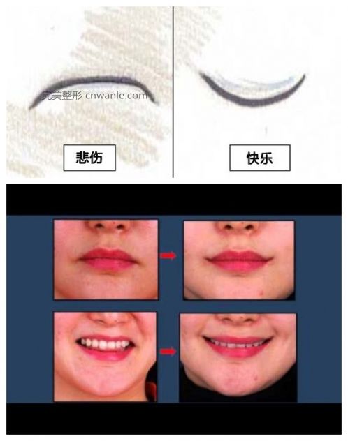 微笑也可定格 韓國流行“嘴角上揚”手術