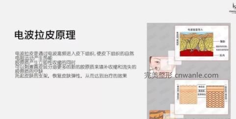 電波拉皮？是個什么鬼