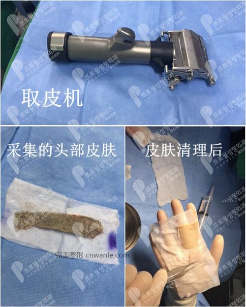 韓國profile普羅菲耳整形醫(yī)院頭皮移植機(jī)