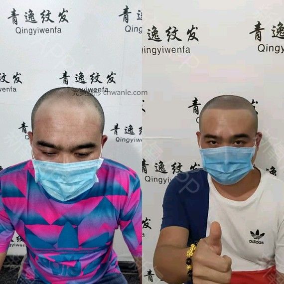 半永久紋發(fā)際線