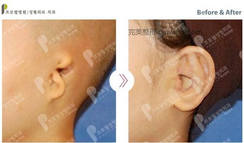 韓國profile普羅菲耳整形醫(yī)院小耳癥矯正案例