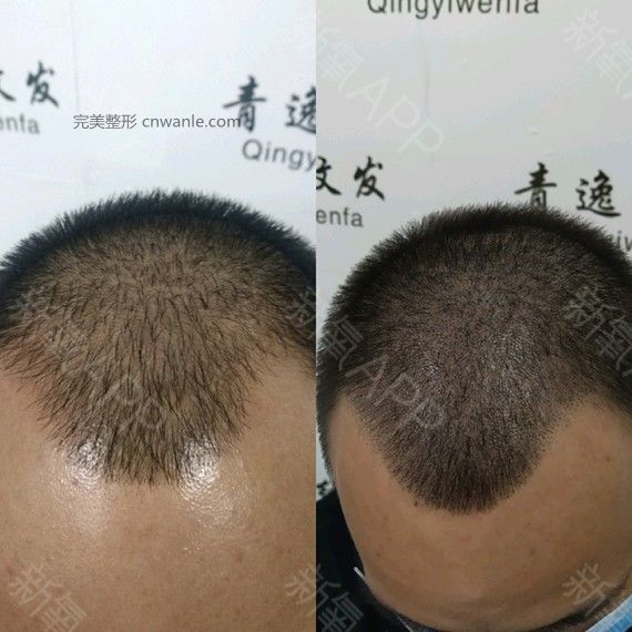 半永久紋發(fā)際線