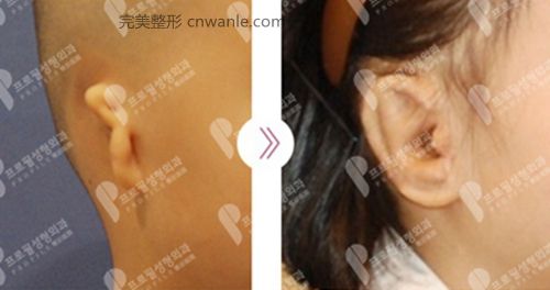 韓國profile普羅菲耳整形醫(yī)院花生耳矯正案例