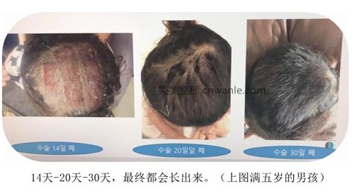 韓國profile普羅菲耳整形醫(yī)院頭皮取皮后恢復(fù)