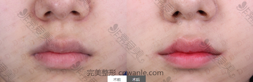 女神醫(yī)院唇部整形案例對(duì)比