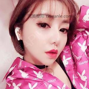 厚唇改薄術(shù)后220天_嘴角上揚(yáng)術(shù)術(shù)后220天_M唇手術(shù)術(shù)后220天_唇形矯正術(shù)后220天_唇型美化術(shù)后220天_口唇整形術(shù)后220天_Ceci老姐分享圖片4