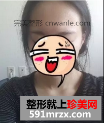種植頭發(fā)前后效果展示 種植頭發(fā)案例分享