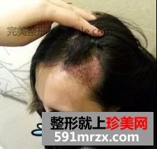 種植頭發(fā)前后效果展示 種植頭發(fā)案例分享