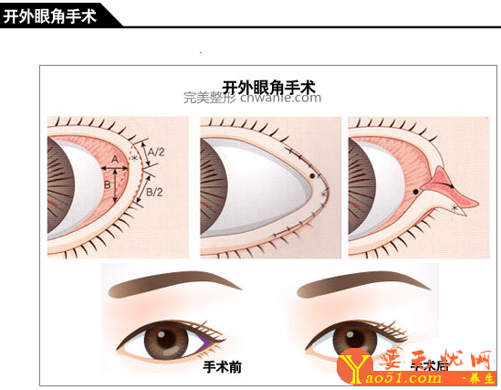 做手術(shù)開(kāi)眼角眼睛會(huì)變大嗎