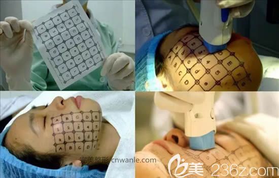 電波拉皮操作過程圖