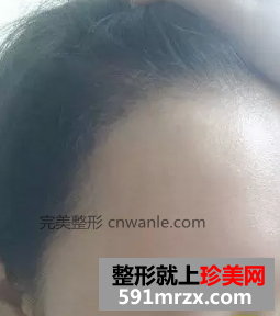 種植頭發(fā)前后效果展示 種植頭發(fā)案例分享
