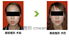 整形材料