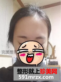 種植頭發(fā)前后效果展示 種植頭發(fā)案例分享