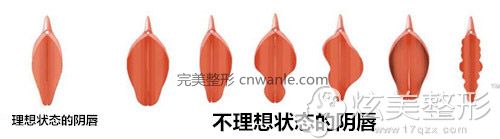 陰唇整形