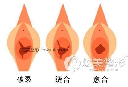 處女膜修復(fù)手術(shù)原理