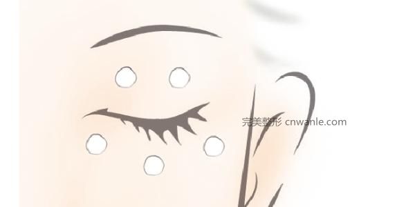 開眼角手術(shù)需要多長時間的恢復(fù)期