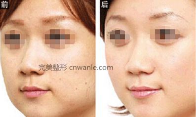 怎樣去除嘴角紋