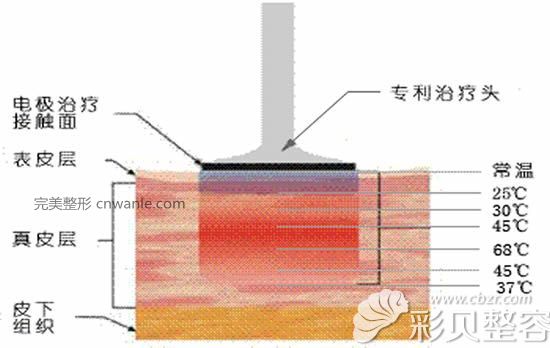 電波拉皮除皺作用原理