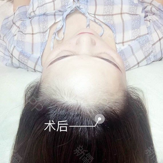 半永久紋發(fā)際線