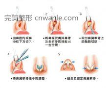 荊州鼻尖整形手術(shù) 讓你的鼻子美到極致