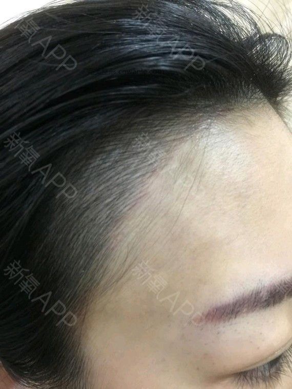 半永久紋發(fā)際線