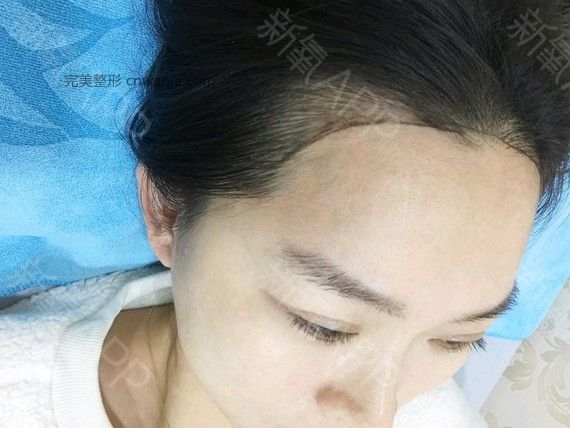 半永久紋發(fā)際線