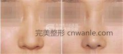荊州是如何進(jìn)行鼻尖整形的呢？