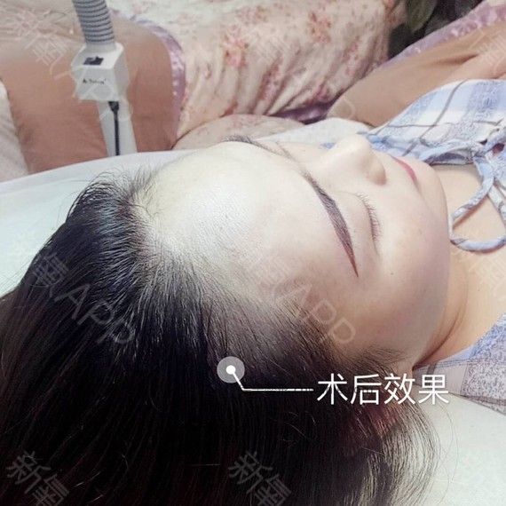 半永久紋發(fā)際線