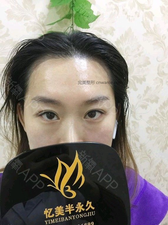 半永久紋發(fā)際線