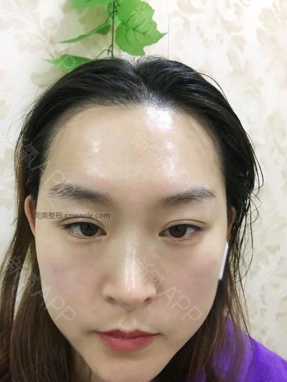半永久紋發(fā)際線