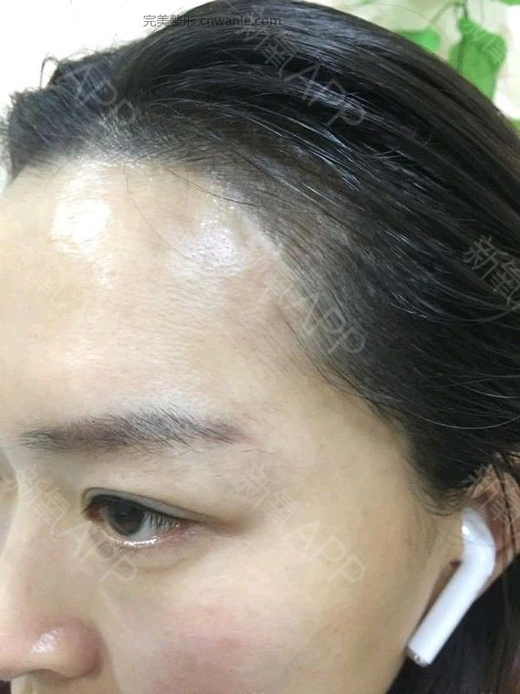 半永久紋發(fā)際線