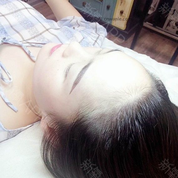 半永久紋發(fā)際線