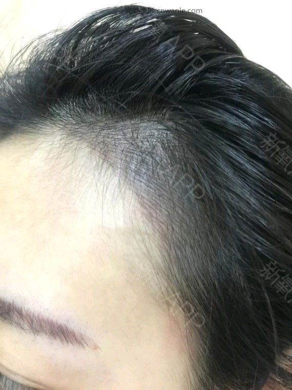 半永久紋發(fā)際線